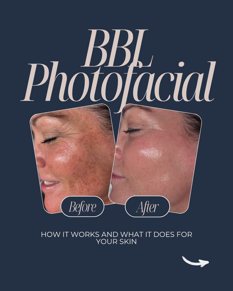 Before and after pair of a client's face showing reduced redness and pigment after a BBL photofacial