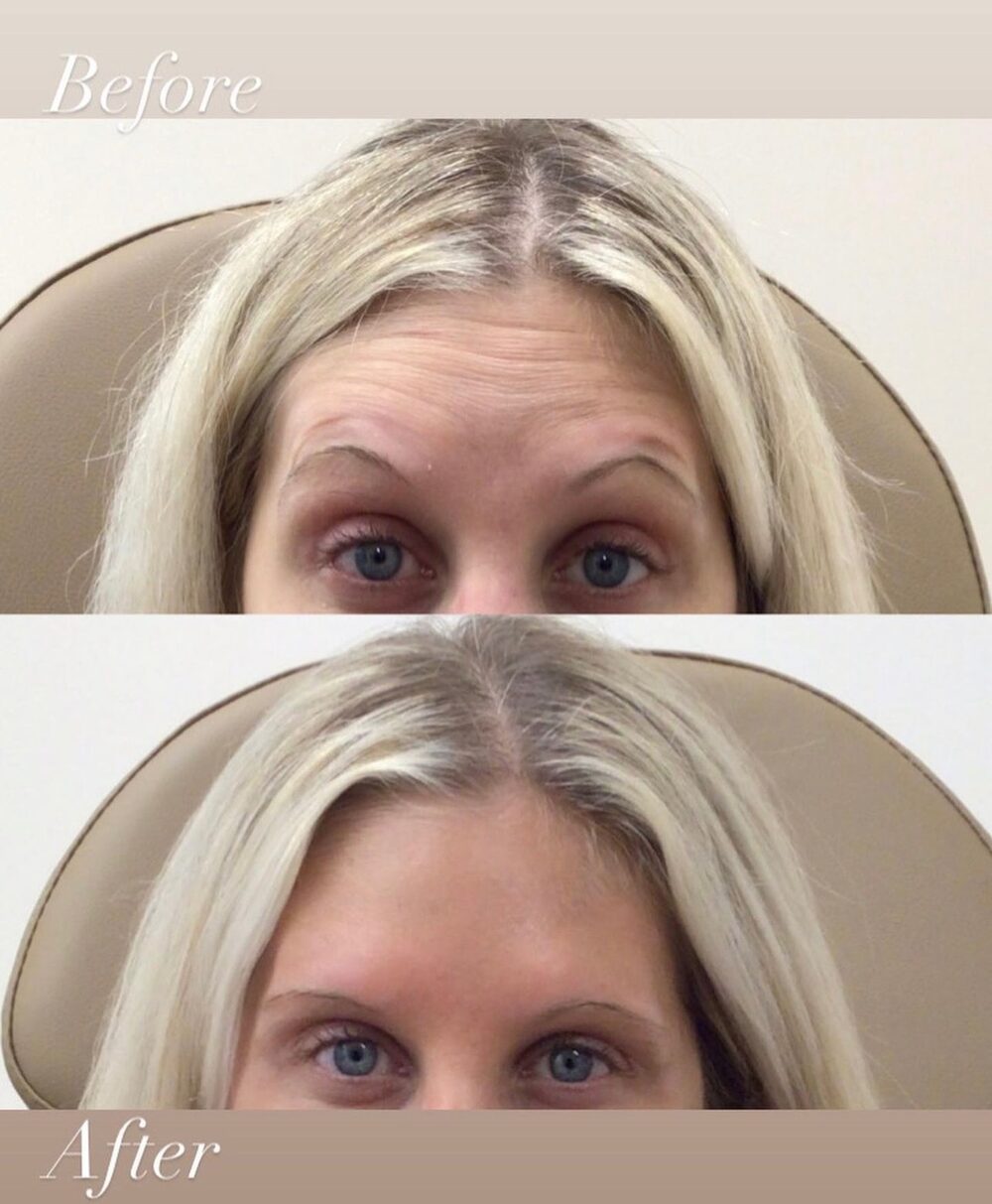Before and after of a client's forehead with brows raised, stacked: horizontal forehead lines above; a smooth forehead below after Botox