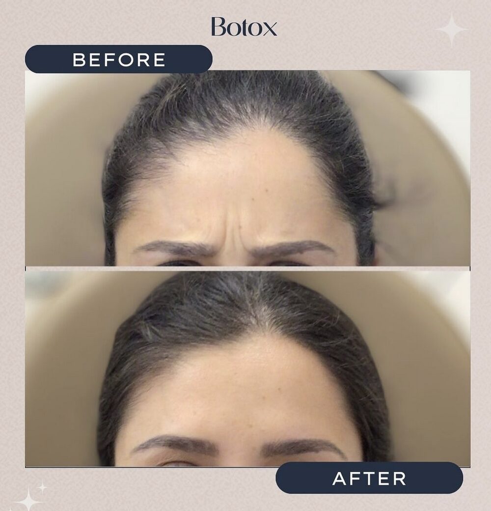 Before and after of a client's forehead while frowning, stacked: deep lines between the brows above; a smooth brow below after Botox