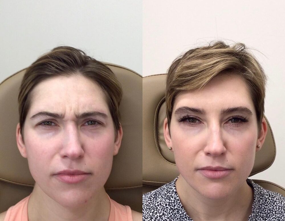 Side-by-side before and after of the same client frowning: lines between the brows on the left; a relaxed brow on the right after Dysport