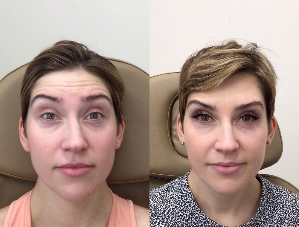 Side-by-side before and after of a client's face: before Dysport on the left; a smoother forehead and brow on the right after treatment
