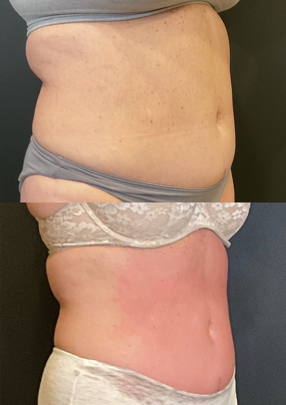Before and after of a client's waist from the side, stacked: a fuller waist and abdomen above; a slimmer, tighter waist below after fat reduction and skin tightening