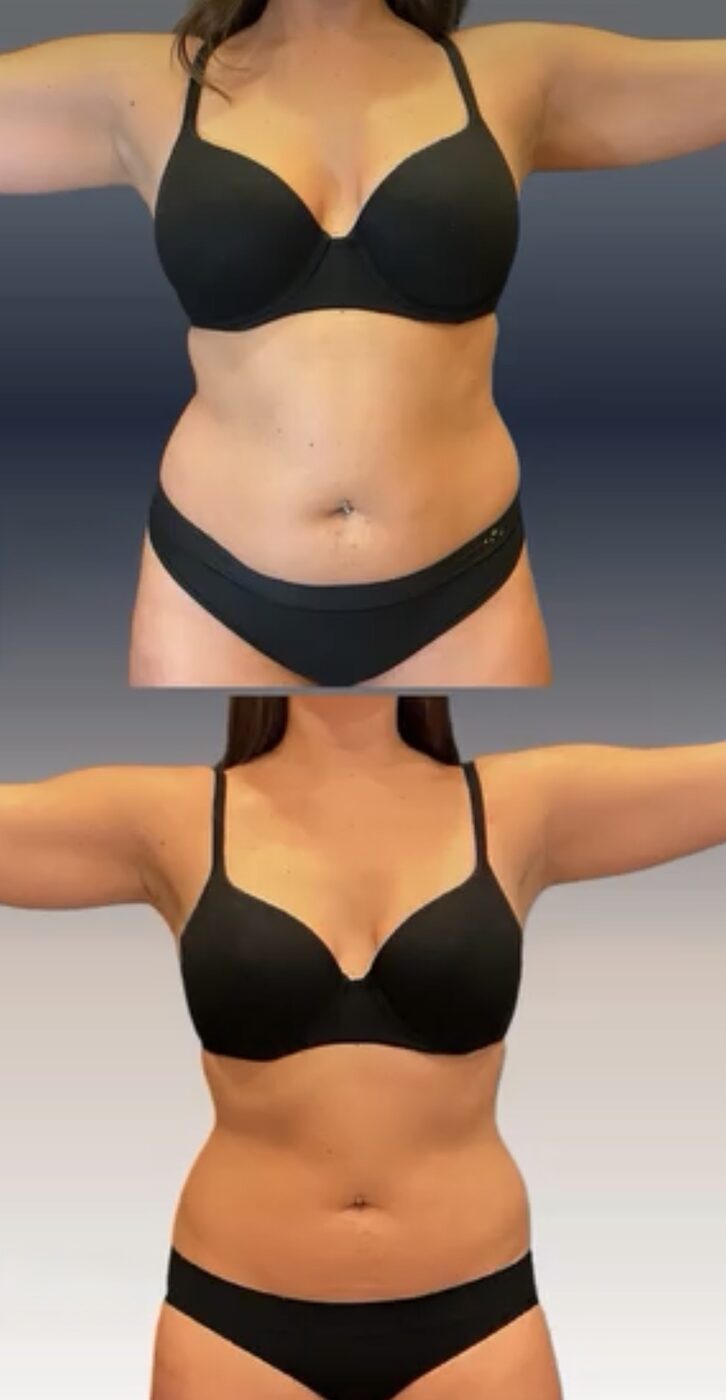 Before and after of a client's torso from the front, stacked: a wider waist above; a narrower, more defined waist below after three fat reduction treatments