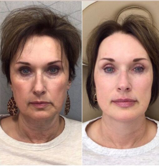 Side-by-side before and after of a client's face: lost volume and deeper lines on the left; fuller cheeks and softer lines on the right after filler and tox