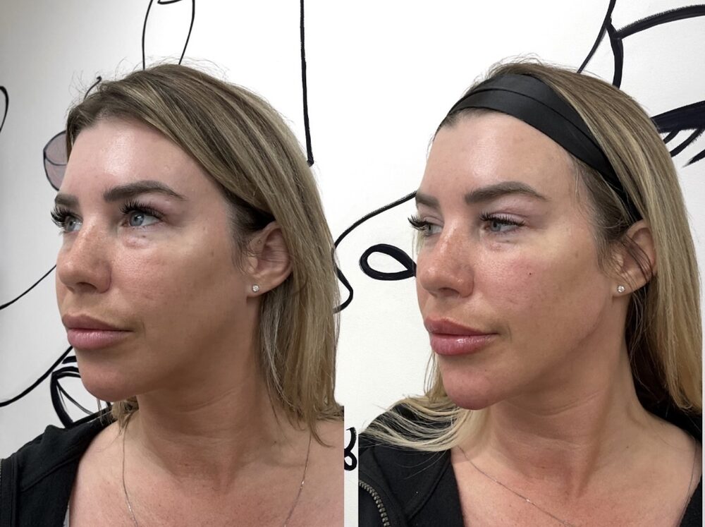 Three-quarter view before and after of a client's jawline: softer jaw on the left; a cleaner, more contoured jawline on the right