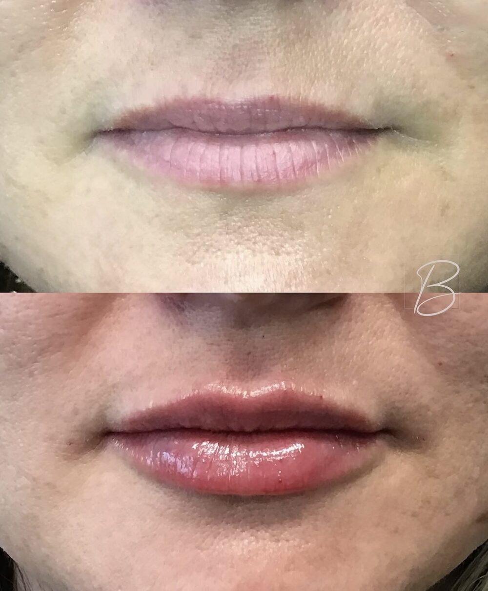 Close-up before and after of a client's lips, stacked: thin, pale lips above; fuller, smoother lips below after lip filler