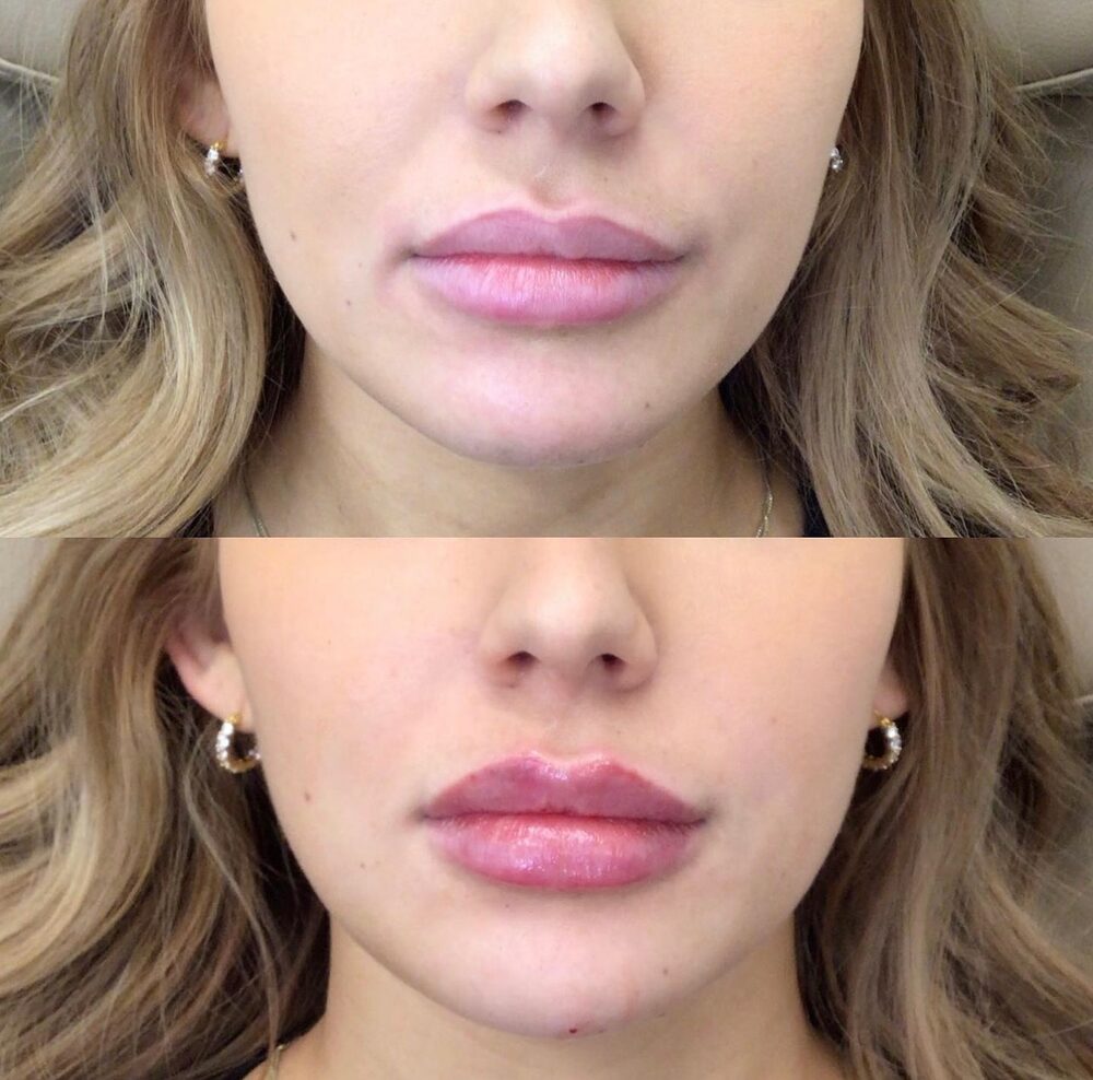 Before and after of a client's lips, stacked: natural lips above; fuller, more defined lips below after lip filler at Beauty HQ