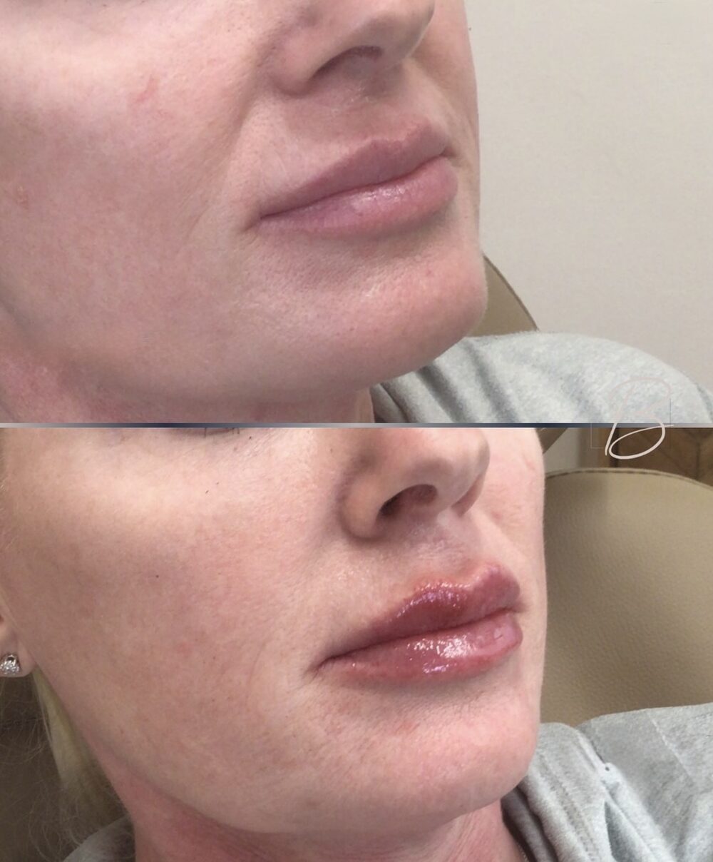 Three-quarter view before and after of a client's lips, stacked: thinner lips above; fuller, lifted lips below after lip filler