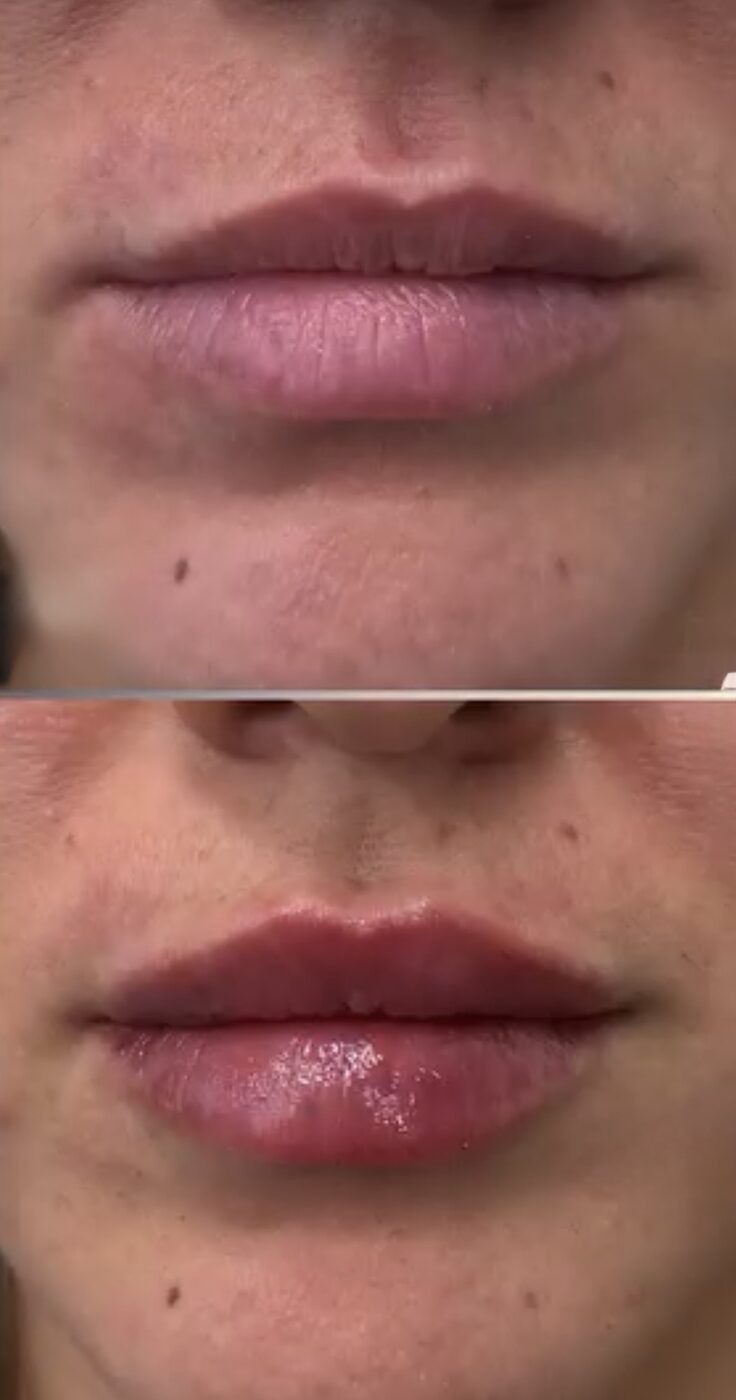 Close-up before and after of a client's lips, stacked: flatter lips above; fuller, rounded lips below after lip filler