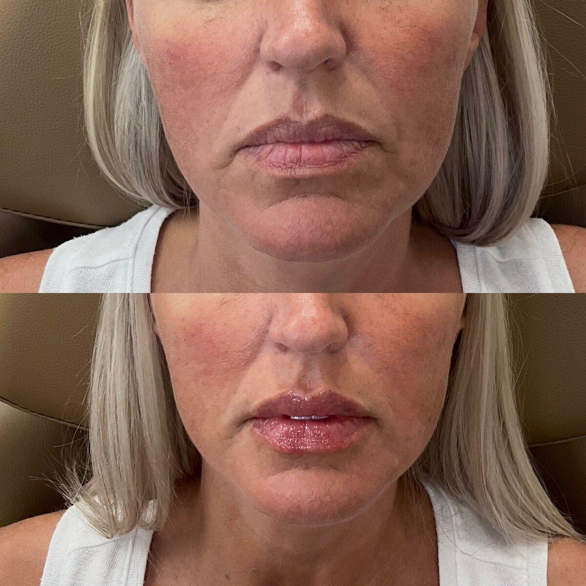Before and after of a client's lips, stacked: thinner, less defined lips above; fuller, hydrated lips with a defined border below after HA filler