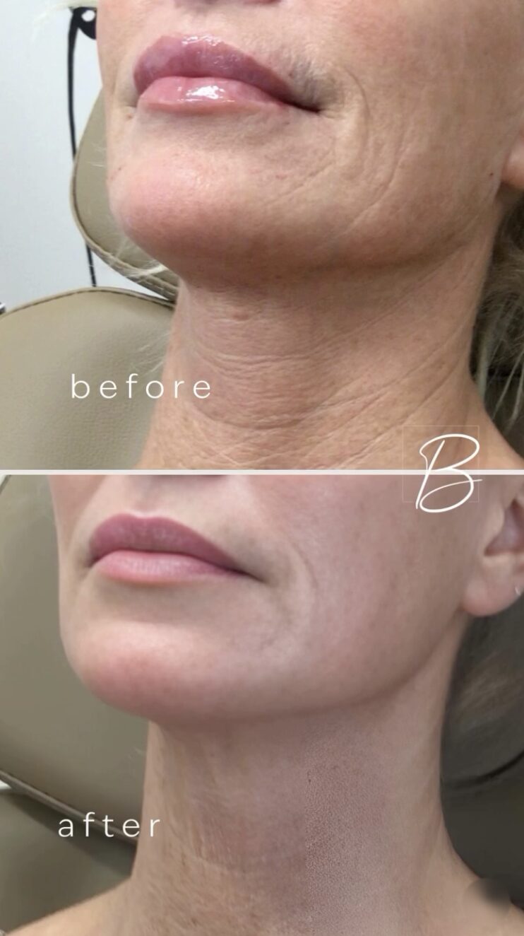 Before and after of the same client's neck and jaw from the side, stacked: lined skin above; smoother skin below after Micro-Tox