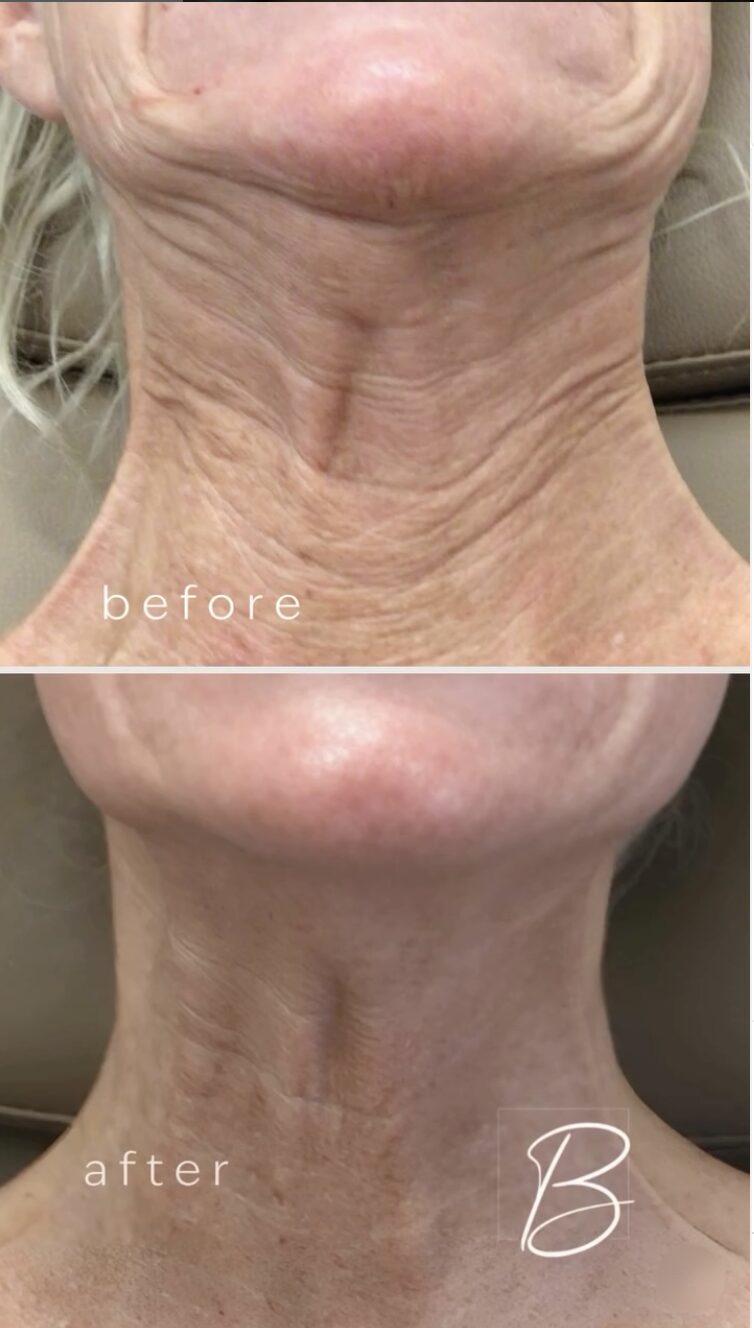 Before and after of a client's neck from the front, stacked: creased, crepey skin above; smoother, tighter skin below after Micro-Tox