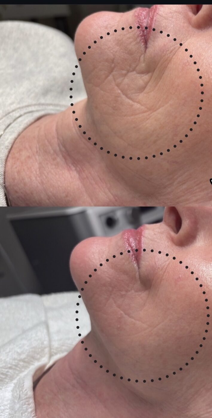 Before and after of a client's chin and mouth area, stacked: fine lines and creased texture above; smoother skin below after three No Filter Needed SkinPen treatments