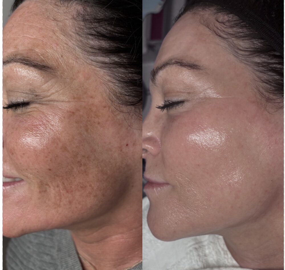 Side-by-side profile of the same client: sun spots across the cheek on the left before treatment; clear, glowing skin on the right after three photofacials and regular Diamond Glow facials