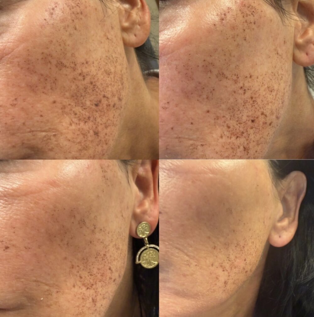 Four photos of a client's cheek over four days after one full-face photofacial: sun spots darken and then begin to lift away
