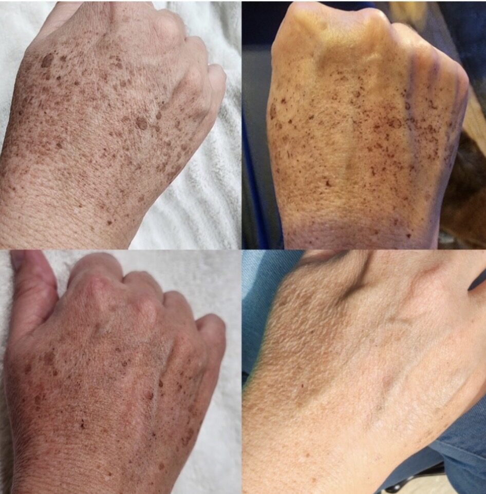 Four photos of a client's hand over two weeks after a photofacial: dense sun spots darken, then fade to clearer skin