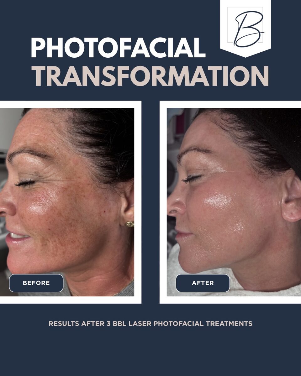 Side-by-side before and after of a client's cheek after three BBL laser photofacial treatments: dense sun spots and uneven tone on the left, clearer, more even skin on the right