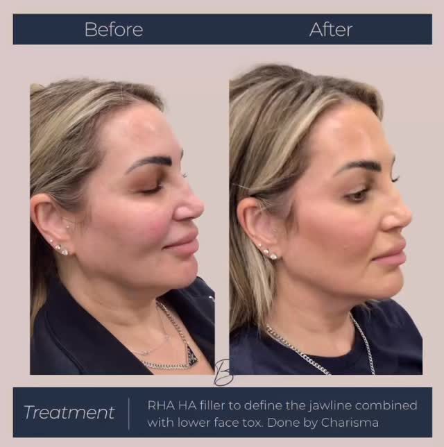 Profile before and after of a client's jawline: softer, less defined jaw on the left; sharper, more defined jawline on the right after RHA filler and lower-face tox