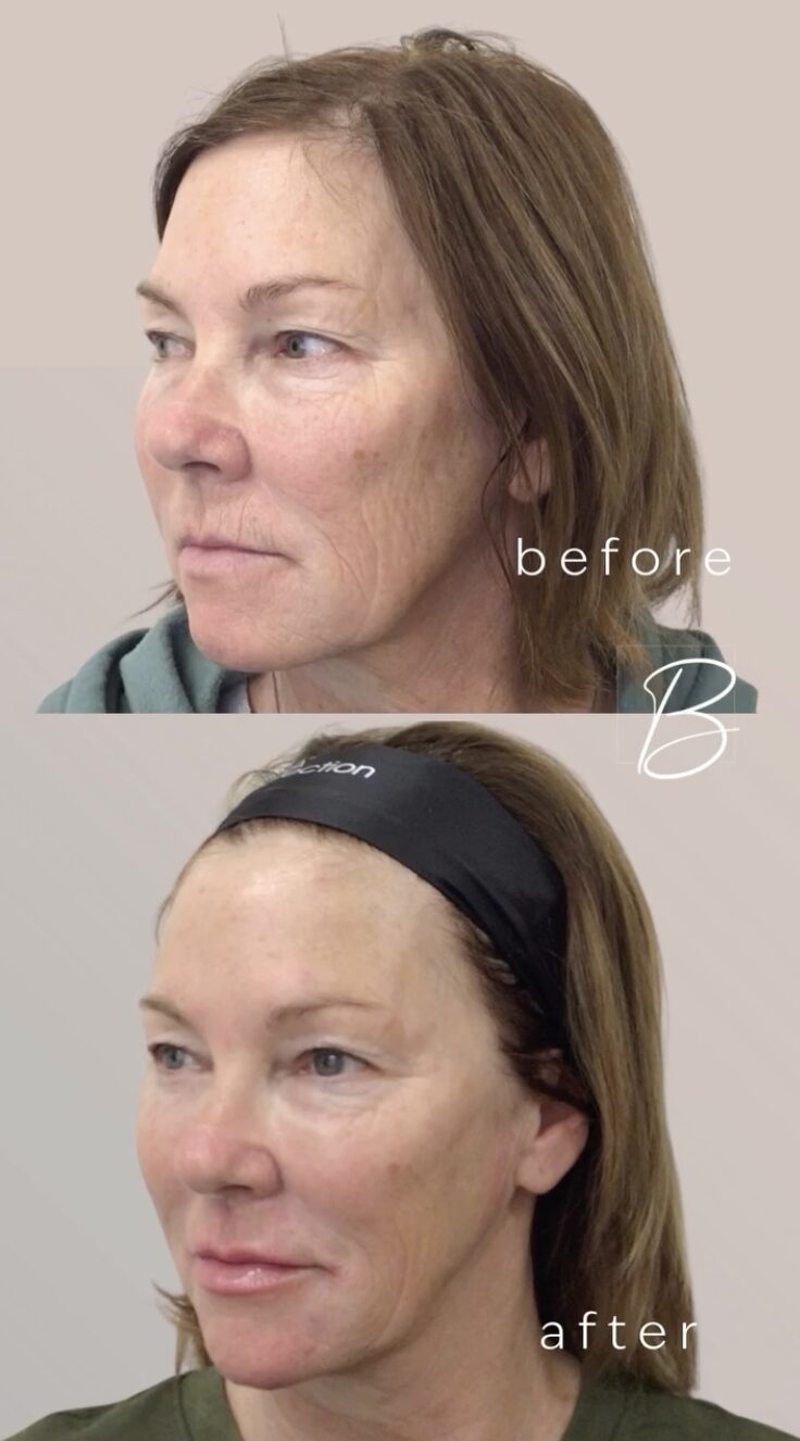 Before and after of the same client's face from a three-quarter view, stacked: deeper folds above; a smoother, lifted profile below after Sculptra, HA fillers and tox