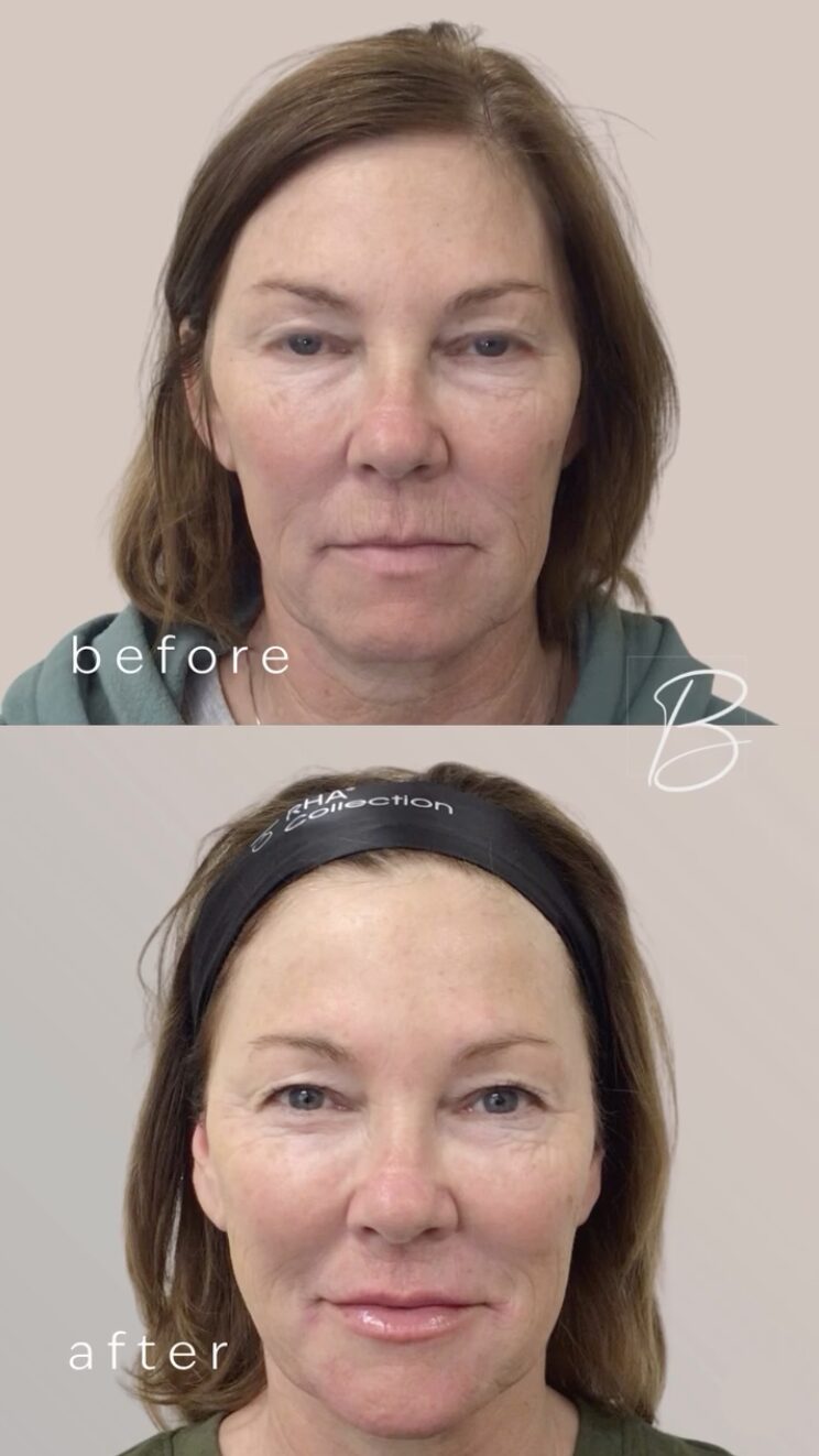 Before and after of a client's face from the front, stacked: tired, hollowed features above; lifted, fuller features below after Sculptra, HA fillers and tox