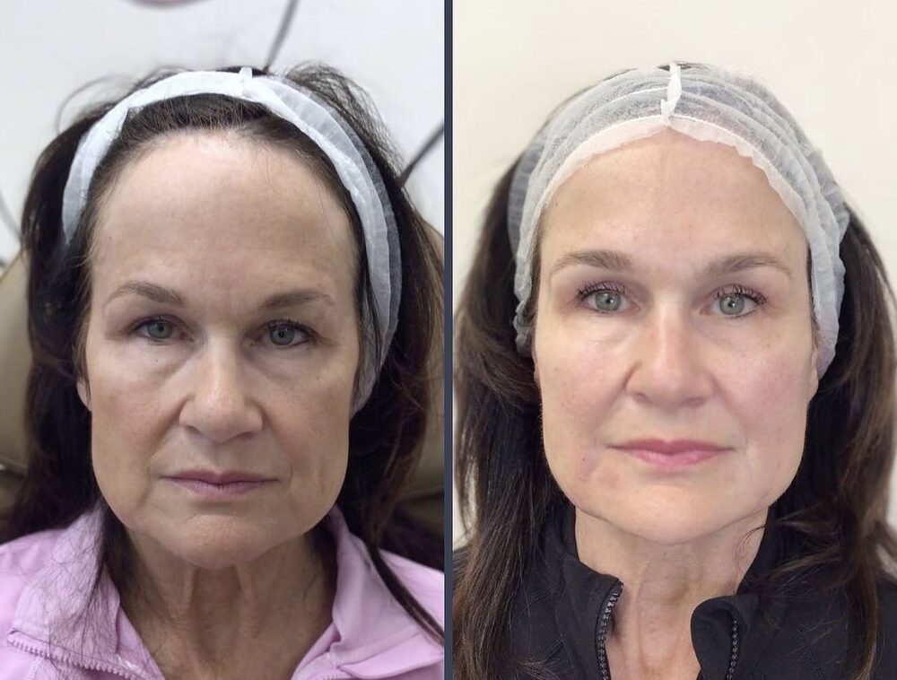 Side-by-side before and after of a client's face: hollowing and deeper folds on the left; restored volume and smoother skin on the right after Sculptra and tox