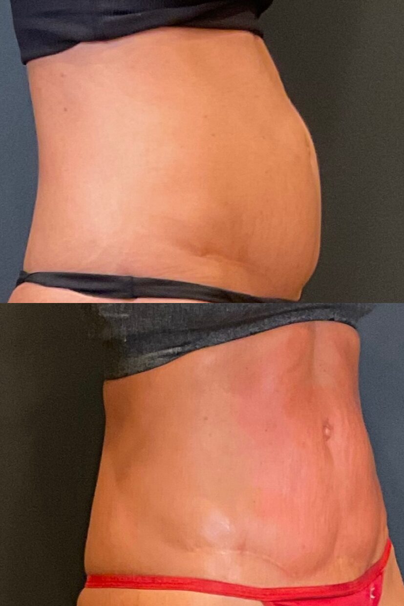 Before and after of the same client's abdomen from the side, stacked: a rounder profile above; a flatter profile below after the Tri-Body Package