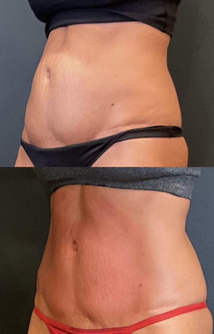 Before and after of a client's abdomen from the front, stacked: a fuller abdomen above; a flatter, firmer abdomen below after the Tri-Body Package