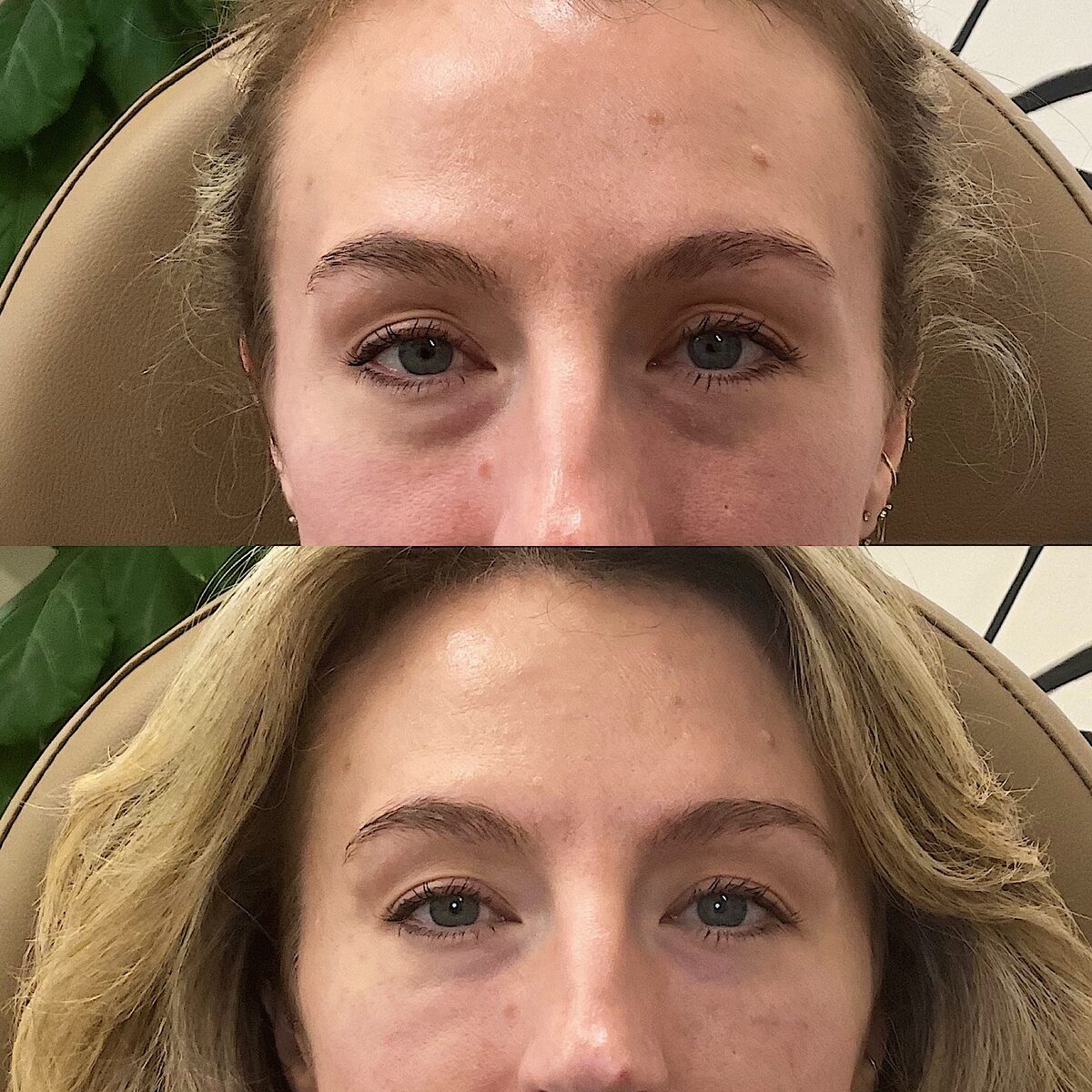 Before and after of a client's under-eye area, stacked: hollow, shadowed under-eyes above; brighter, smoother under-eyes below after PDGF treatment