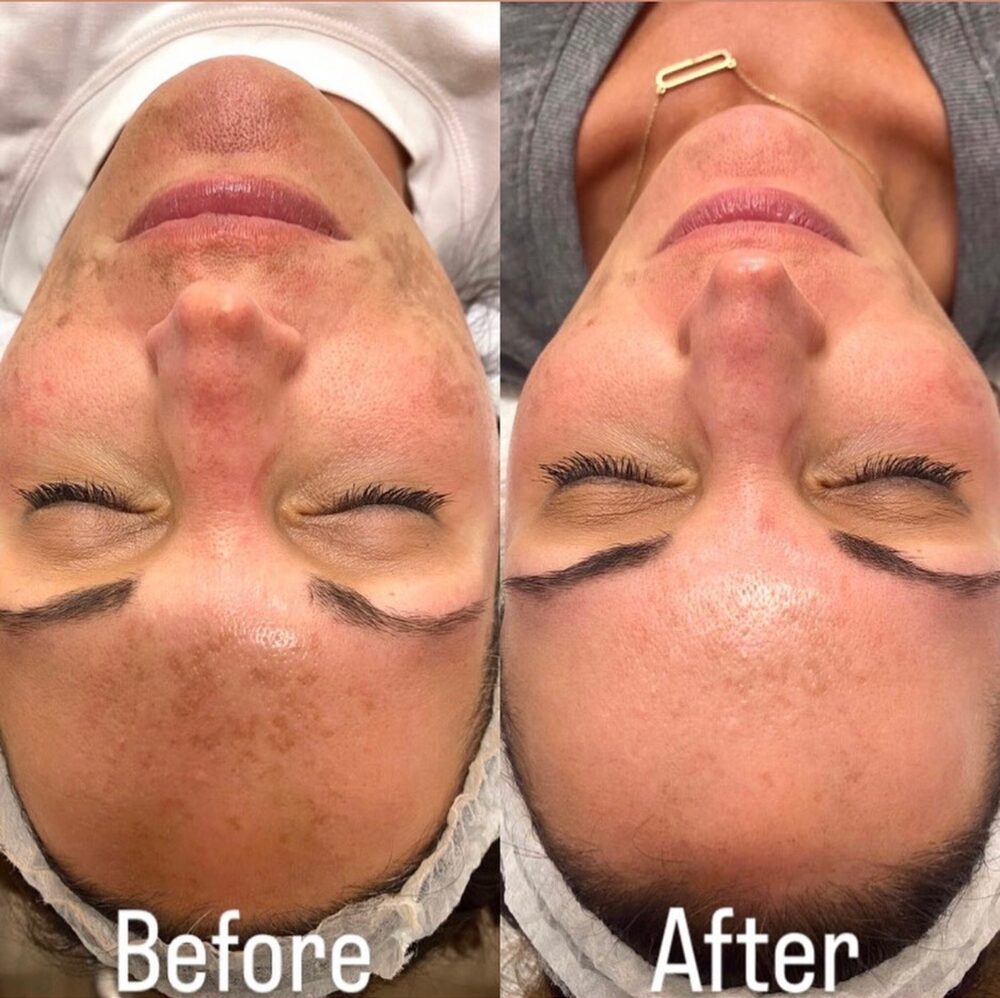 Side-by-side before and after of a client's face: patchy pigment on the left; a clearer, more even tone on the right after one Vi-Peel