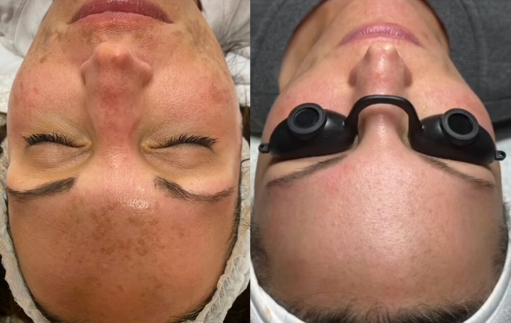 Side-by-side before and after of the same client's face: pigment across the forehead and cheeks on the left; even, clear skin on the right after three Vi-Peels